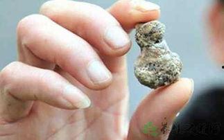 肾结石可以吃烧瓜